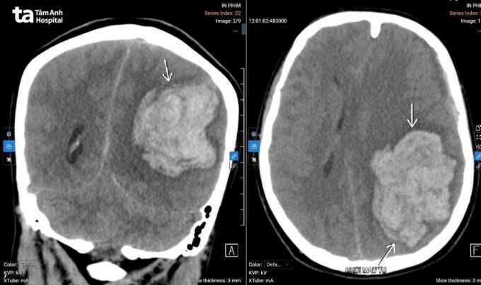 Đột quỵ ở tuổi 22