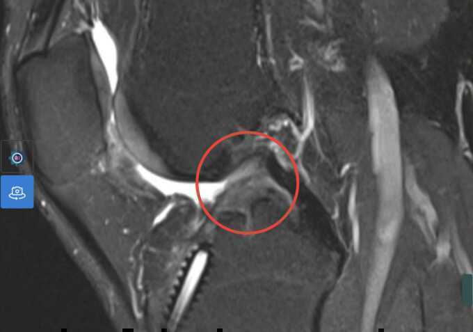 Tái tạo dây chằng sau hai lần đứt