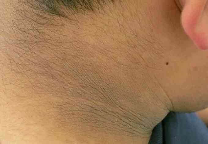 Bệnh gai đen ở người béo phì