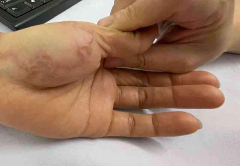 Đau bụng cả tháng không đỡ, phát hiện sinh vật lạ bò dưới da khi đi khám