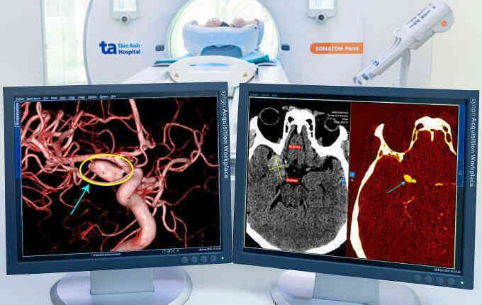 Máy CT lát cắt siêu mỏng AI phát hiện vỡ túi phình mạch máu