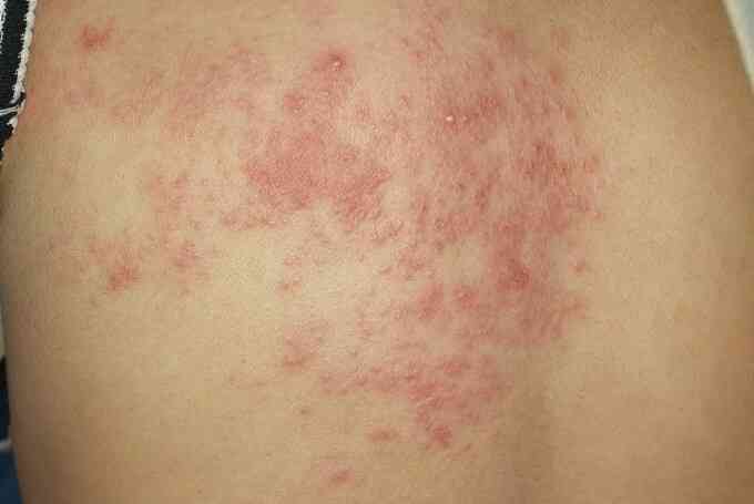 Người lớn đã mắc thủy đậu có cần tiêm vaccine?