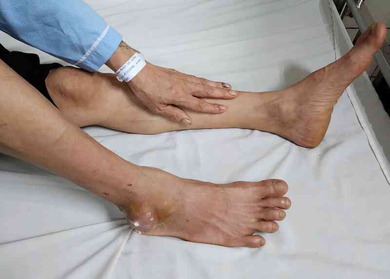 Ăn Tết vô độ, người đàn ông Hà Nội cấp cứu trong tình trạng đau đớn