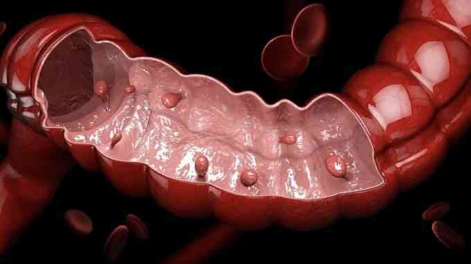 Hàng trăm polyp chi chít đại tràng nam thanh niên