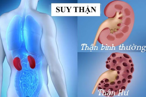 Thận suy yếu âm thầm, 7 việc cần làm ngay để bảo vệ