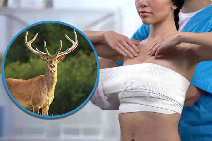 Cô gái bị lừa nâng vòng một bằng collagen động vật giá 8 tỷ