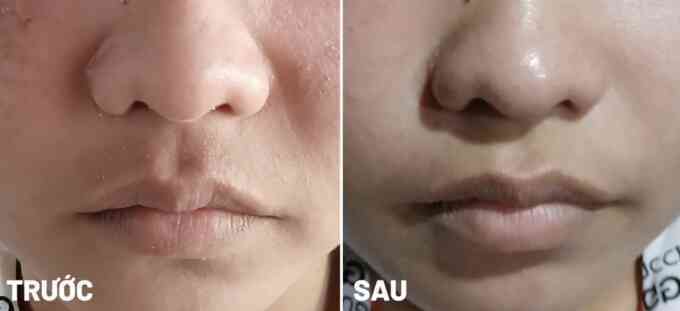 Dị ứng da sau đắp nha đam trị mụn