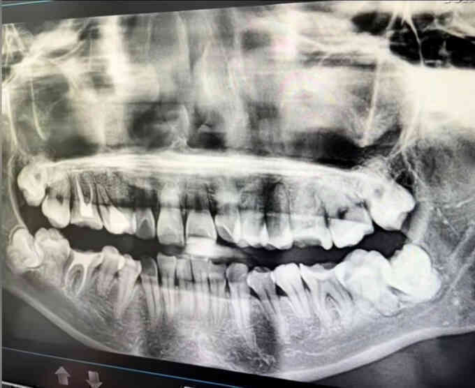 Bê bối bác sĩ nhổ nhầm răng khôn bệnh nhân