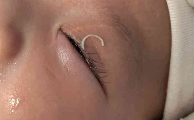 Mẹ cắt móng tay văng vào mắt con gây xuất huyết
