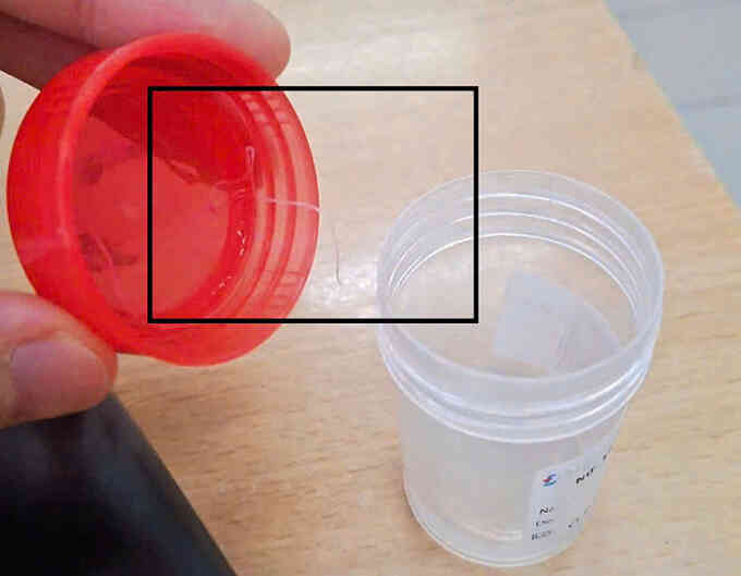 Ký sinh trùng 10 cm sống trong mắt người phụ nữ