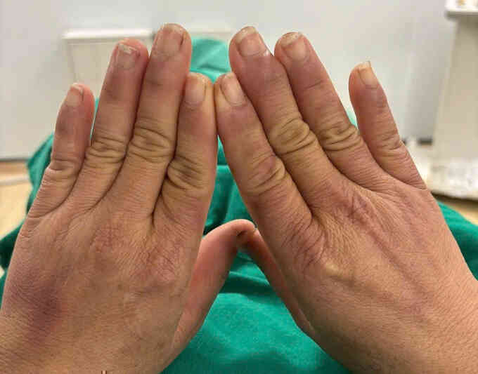Hội chứng khiến tay người phụ nữ tím tái khi chạm nước
