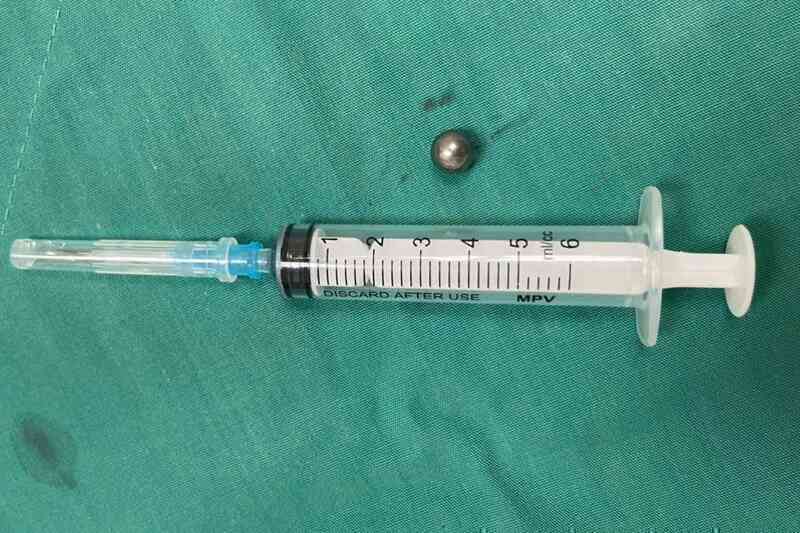 Bé trai 5 tuổi bị đạn từ súng đồ chơi bắn xuyên thủng mặt