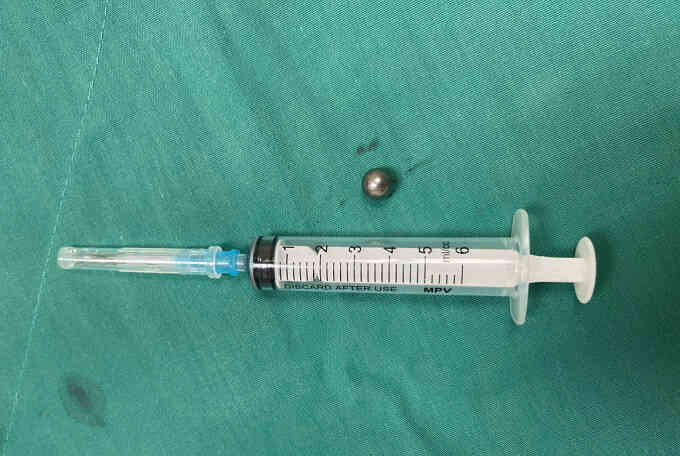 Đạn bi súng đồ chơi xuyên thủng mặt bé trai