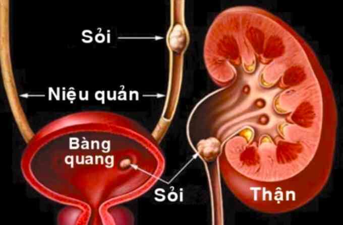 `Sỏi im lặng` âm thầm gây biến chứng nặng