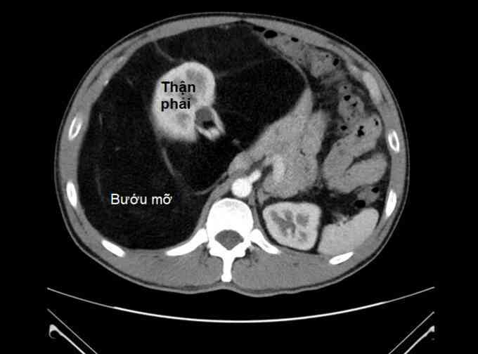 Bướu mỡ 8 kg suýt làm hỏng thận người đàn ông