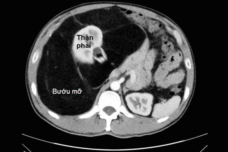 Nhiều người suýt chết vì tưởng "bụng bia"