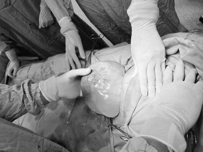 Sinh đôi, một bé còn trong bọc ối