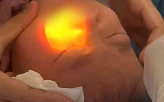 Cấp cứu giữa chuyến du lịch vì cồn rửa tay xịt vào mắt