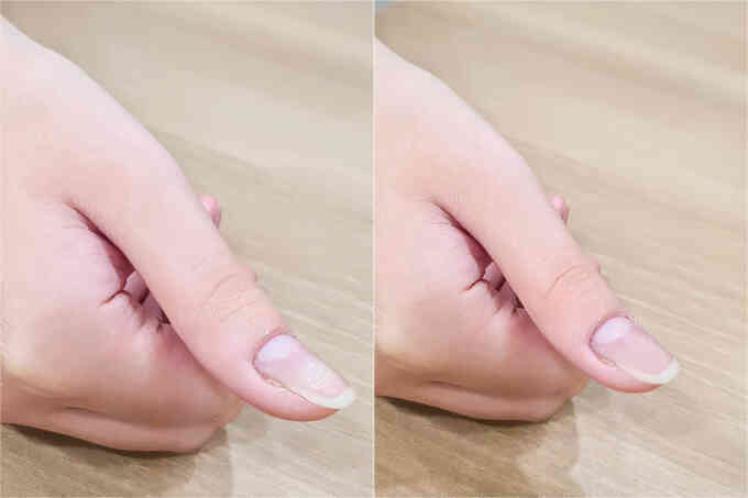 Bắn laser trị u cuộn mạch móng không cần phẫu thuật