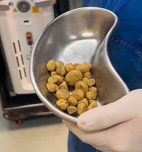 35 viên sỏi trong bàng quang do uống 3 lít nước ngọt mỗi ngày