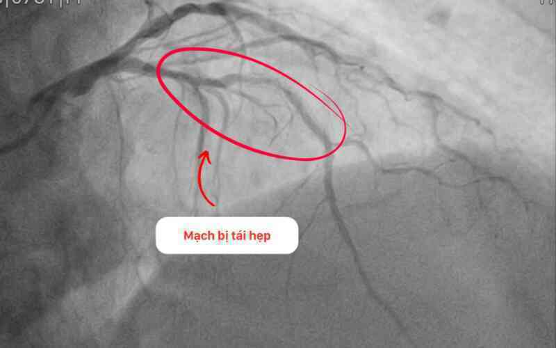 Can thiệp thành công cho bệnh nhân tái hẹp nặng mạch vành sau 15 năm đặt stent