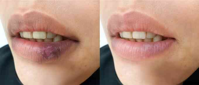 Teo môi vì lupus ban đỏ dạng đĩa