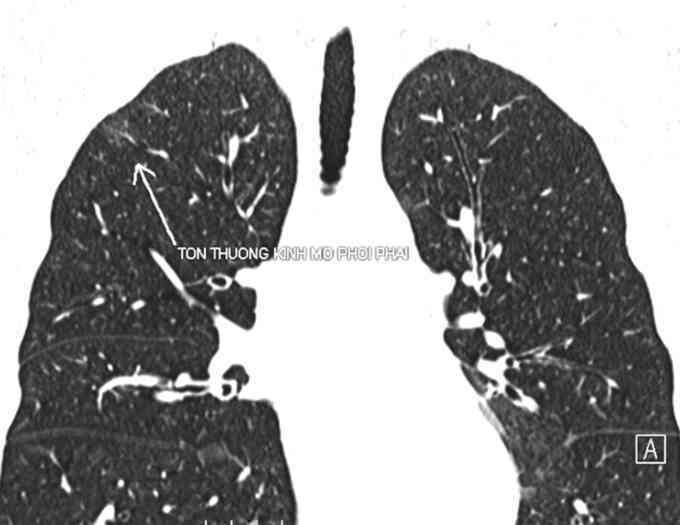 Tưởng ung thư hóa mắc bệnh tự miễn ít gặp