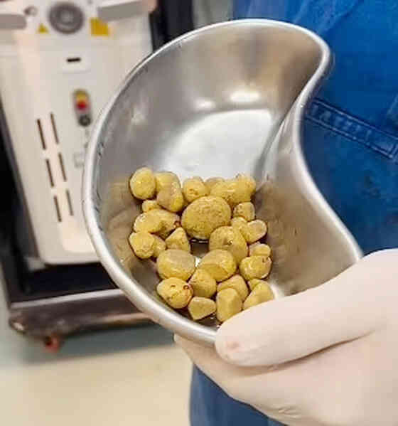 Người đàn ông phải mổ lấy 35 viên sỏi do uống một loại nước phổ biến hằng ngày
