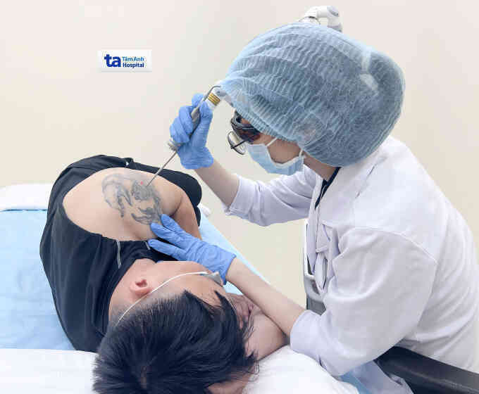 Xóa xăm bằng laser pico