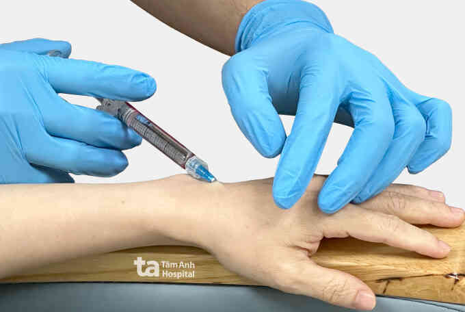 Tiêm filler làm đầy bàn tay được không?