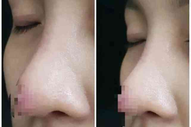 Chuyên gia thẩm mỹ: Người Việt không nên làm mũi "lai Tây, chuẩn Hàn"