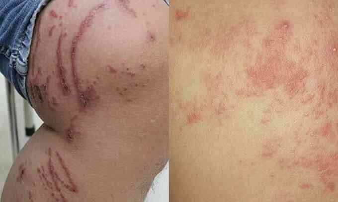 Các bệnh dễ nhầm với zona thần kinh