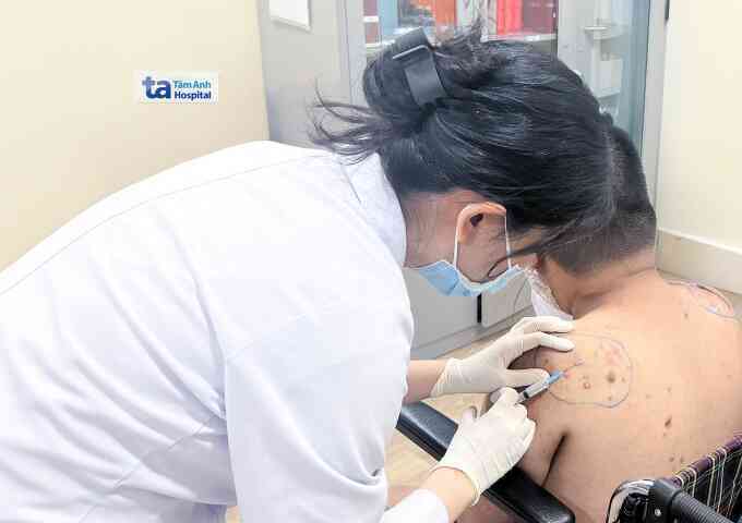 Sẹo lồi do biến chứng mụn
