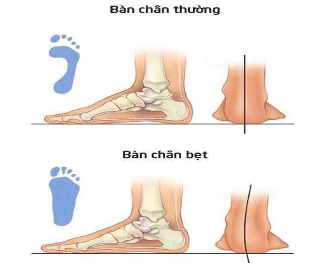 Cách nhận biết sớm bàn chân bẹt ở trẻ