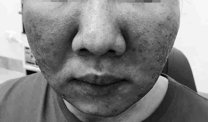 Da cháy xém sau dùng kem `siêu chống nắng`
