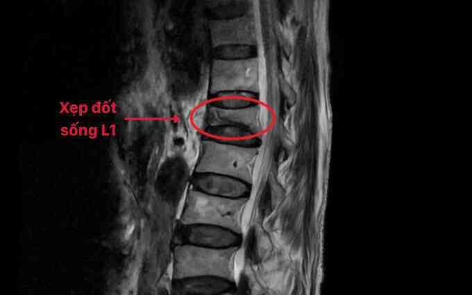Người đàn ông 68 tuổi xẹp đốt sống sau một cái hắt hơi