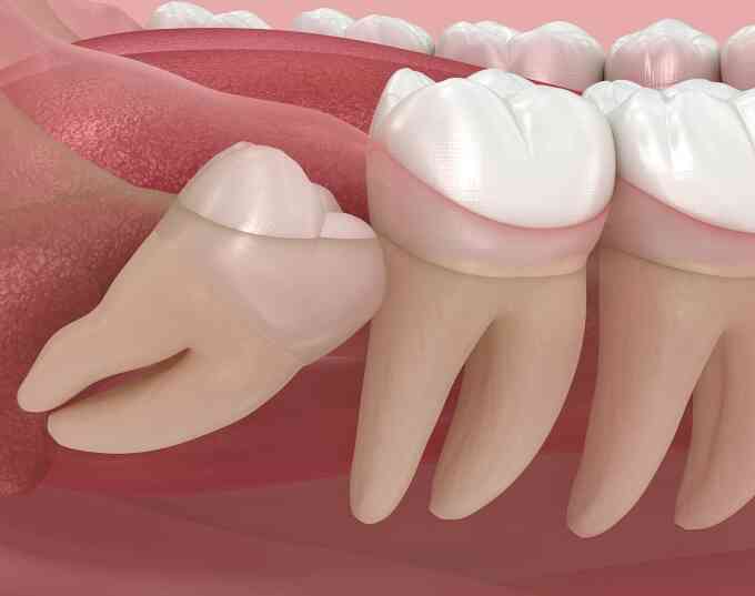 Vì sao một số người không mọc răng khôn?