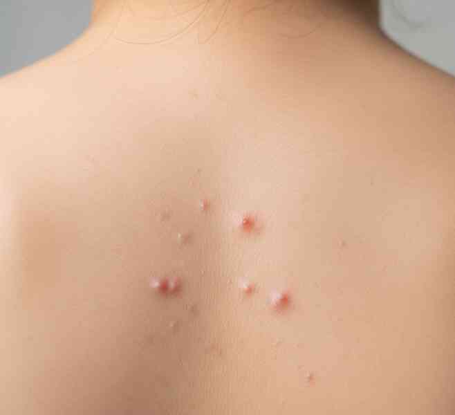 Cách giảm mụn lưng