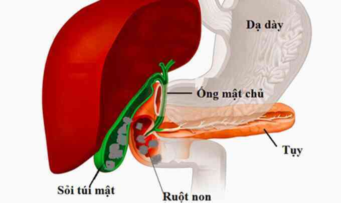 Sỏi mật - quả bom nổ chậm