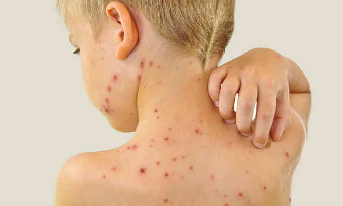 5 biến chứng của bệnh thủy đậu ở trẻ em