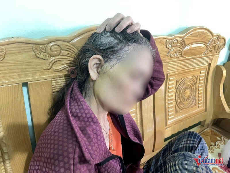 Người phụ nữ 64 tuổi đi thẩm mỹ căng da mặt gặp biến chứng nghiêm trọng