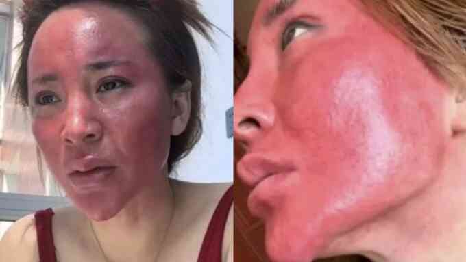 Không tẩy trang suốt 22 năm, người phụ nữ gặp biến chứng da nghiêm trọng