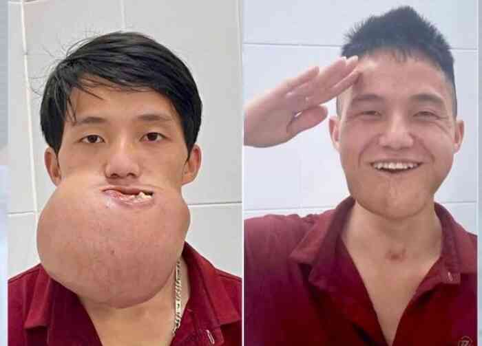 Ca phẫu thuật kéo dài 10 giờ tìm lại nụ cười cho chàng trai trẻ