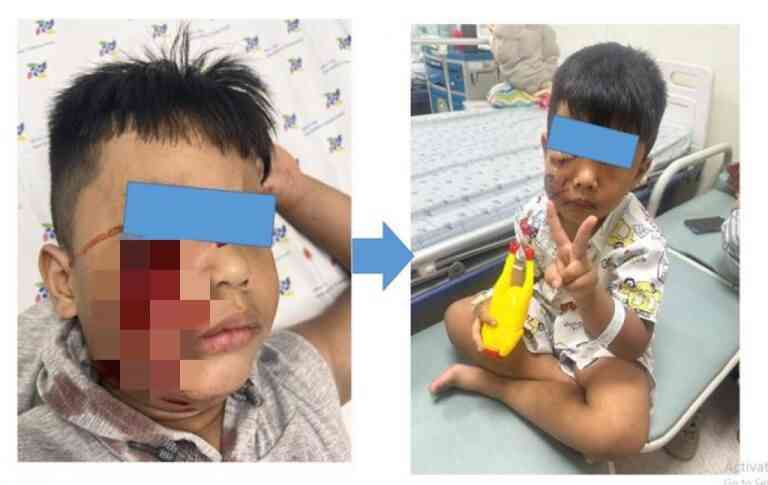 TPHCM: ~Khối nghỉ hè~ liên tục đi cấp cứu vì bị động vật tấn công
