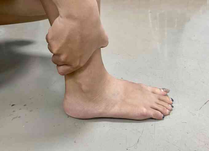 Các biến chứng bệnh gout