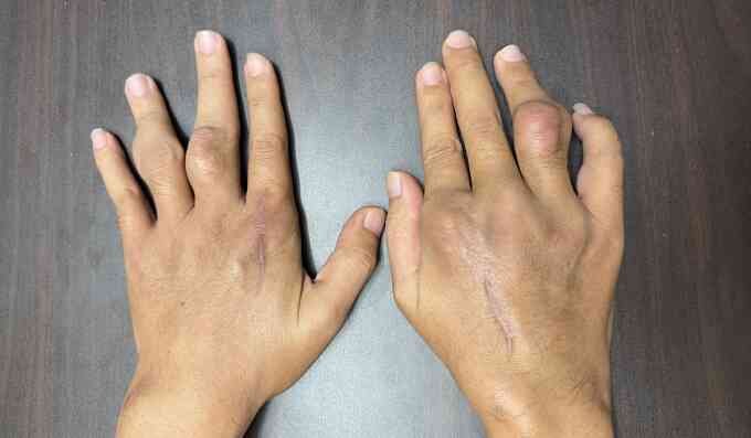 Sống chung bệnh gout từ tuổi đôi mươi