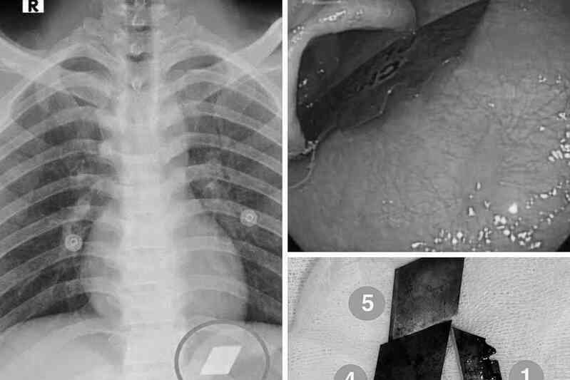 Nam thanh niên 26 tuổi cấp cứu do nuốt nhiều mảnh dao rọc giấy