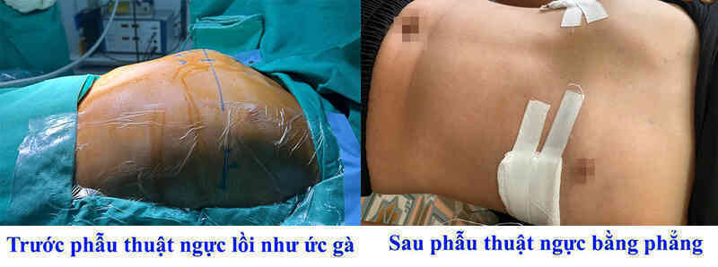 Cậu bé 12 tuổi ngực lồi như ức gà