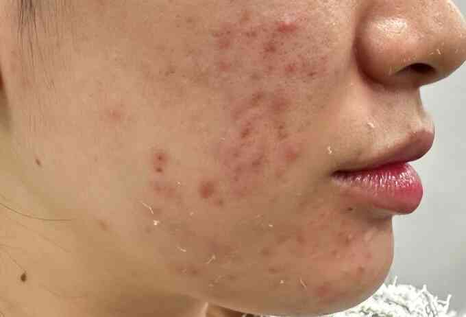 Mụn nội tiết khác mụn trứng cá thế nào?