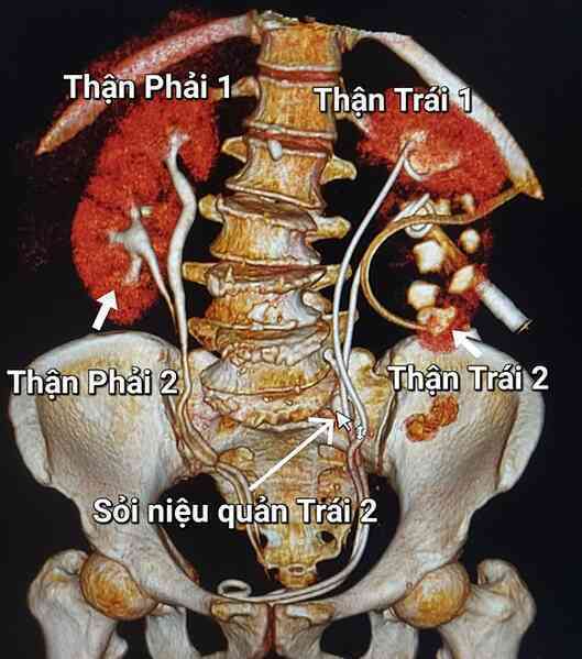 Người phụ nữ có 4 quả thận